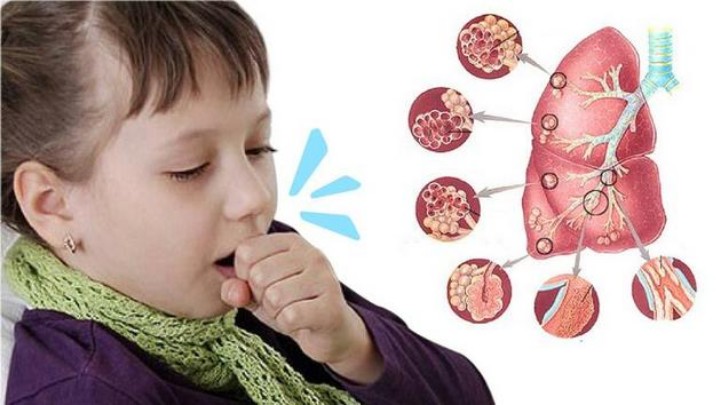Cẩn trọng với bệnh ho gà ở trẻ