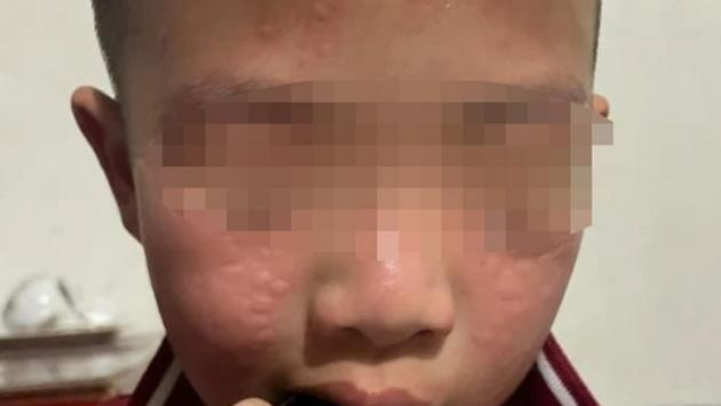 Lý giải việc học sinh bị dị ứng do thuốc diệt muỗi